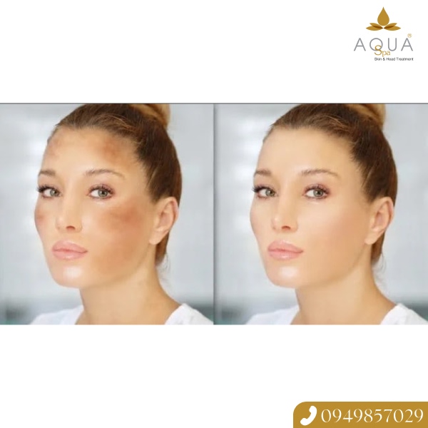 Da Đều Màu, Căng Bóng Nhờ Công Nghệ Điều Trị Nám, Sáng Da Tiên Tiến Tại AQUA SPA