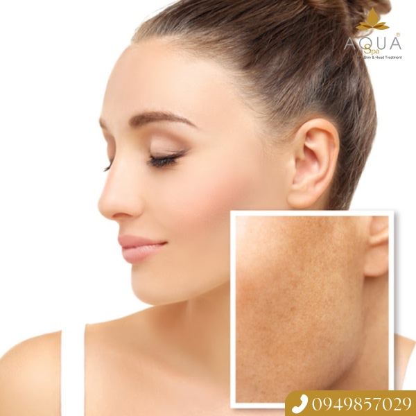 Trải Nghiệm Liệu Trình Trị Mụn Dứt Điểm Với Công Nghệ Skin Recovery Tại AQUA SPA