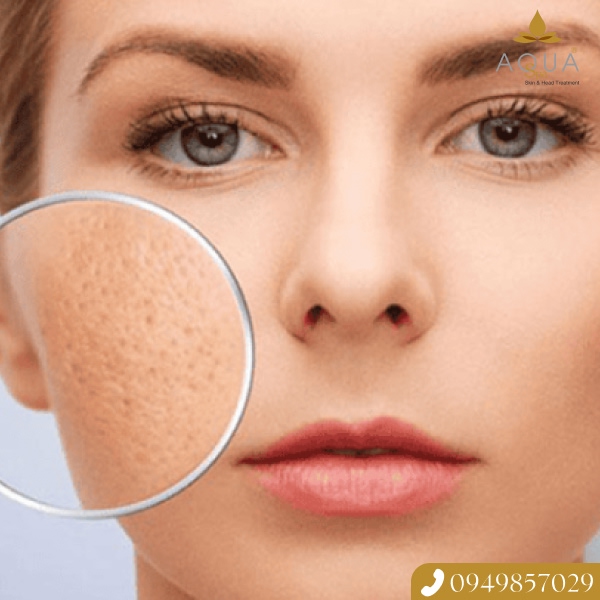Trải Nghiệm Liệu Trình Trị Mụn Dứt Điểm Với Công Nghệ Skin Recovery Tại AQUA SPA